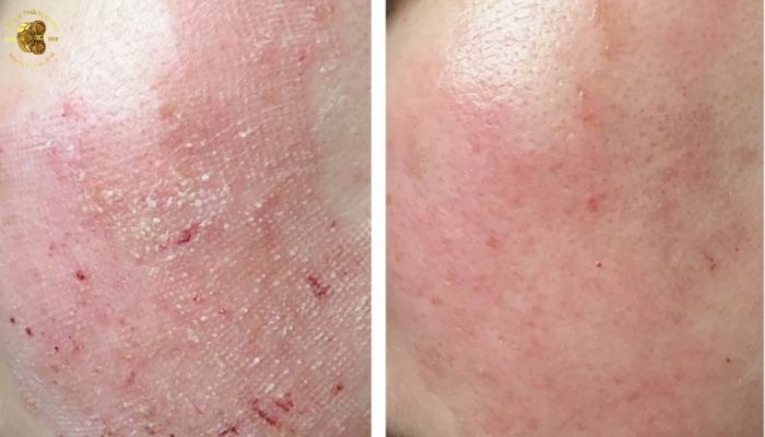 Vì sao một số trường hợp sau laser CO2 lại bị tổn thương da?