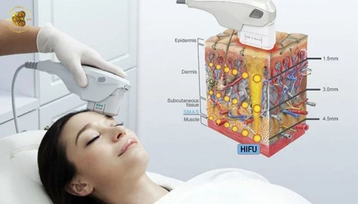 Bạn đã biết công nghệ Hifu chưa?