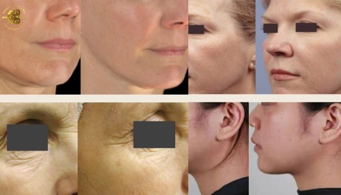Cơ chế hoạt động của Cynosure 5D Collagen Light