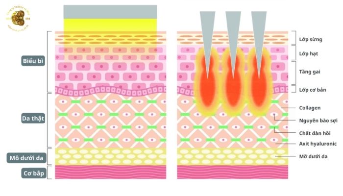 Máy vi kim là gì và cơ chế hoạt động