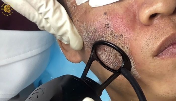 Laser CO2 có hiệu quả với sẹo rỗ lâu năm không?