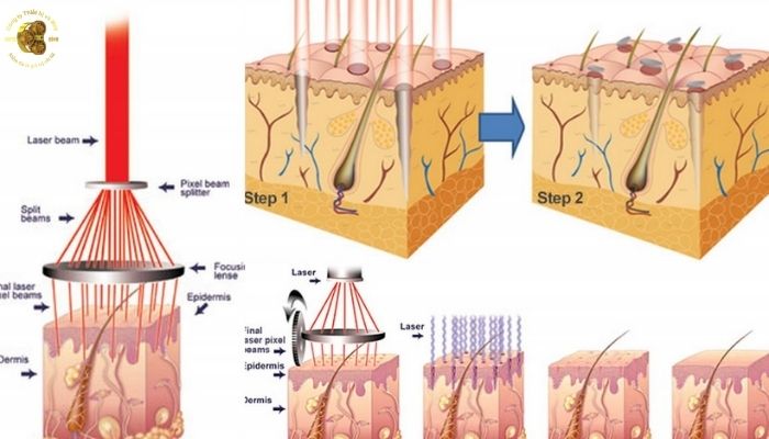 Công nghệ laser CO2 Fractional là gì?