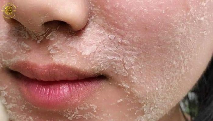 Ưu điểm laser CO2 Fractional so với một số công nghệ tái tạo da khác