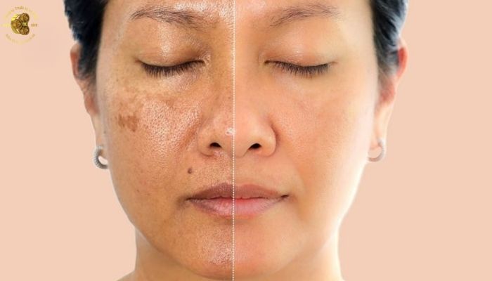 Vai trò của thiết bị trong hiệu quả điều trị laser CO2 Fractional