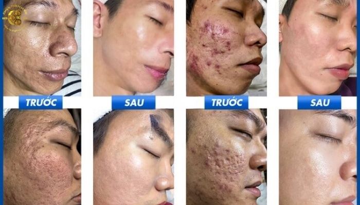 Ưu điểm laser CO2 Fractional trong điều trị sẹo rỗ